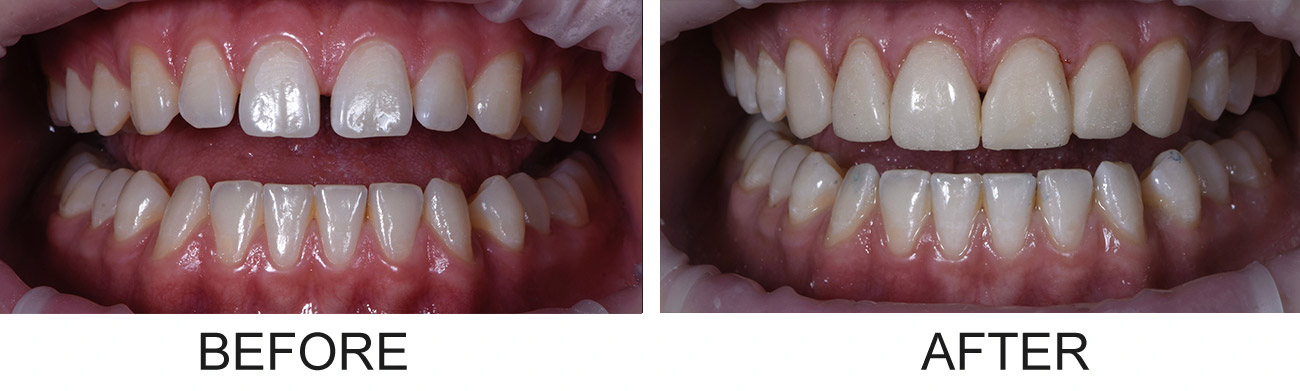 Before and after dental implant transformation