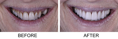 Cosmetic dentistry before and after transformation showing dramatic smile improvement