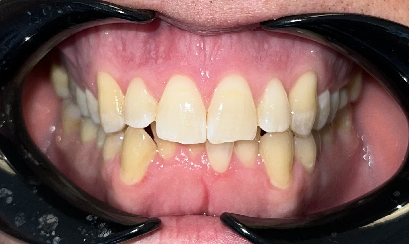 Before Invisalign treatment showing straight and aligned teeth
