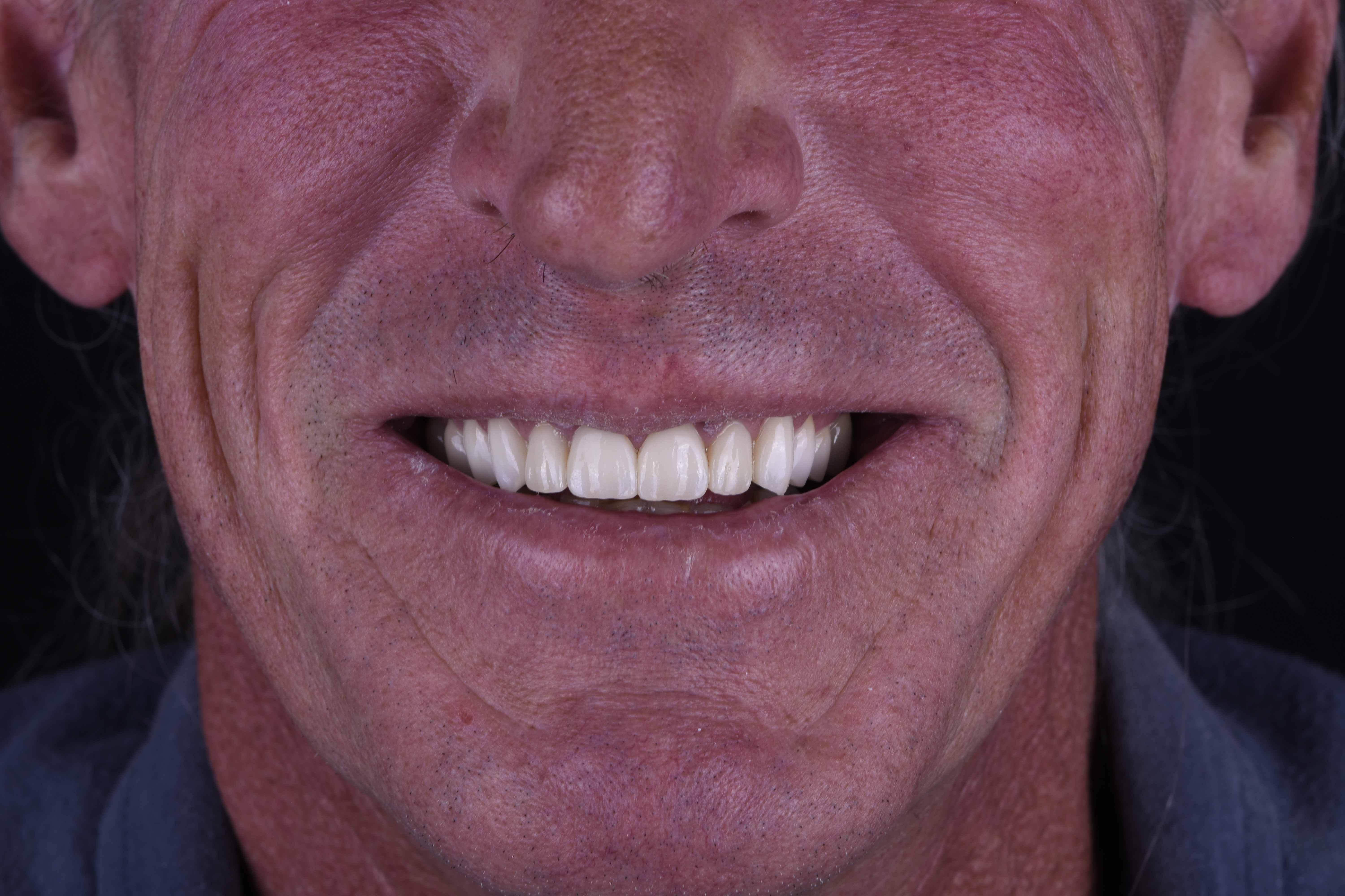 After porcelain veneers showing bright, white, perfectly aligned teeth